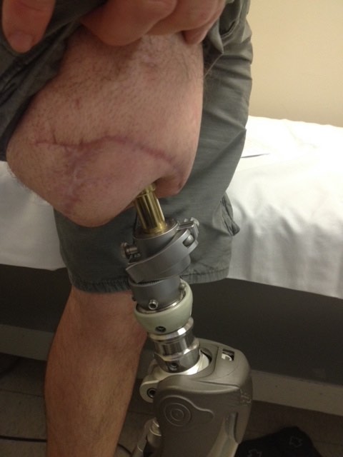 HPC has seen many Osseointegration patients.  After Jon went to Australia to learn more about it.